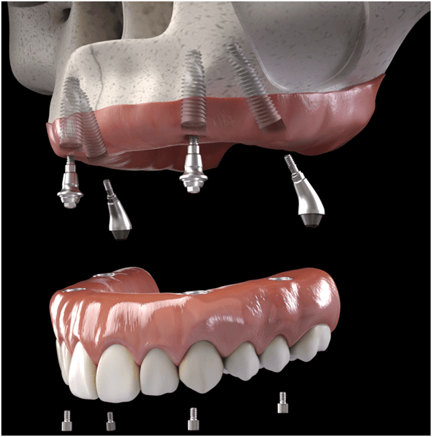 Dental Implants