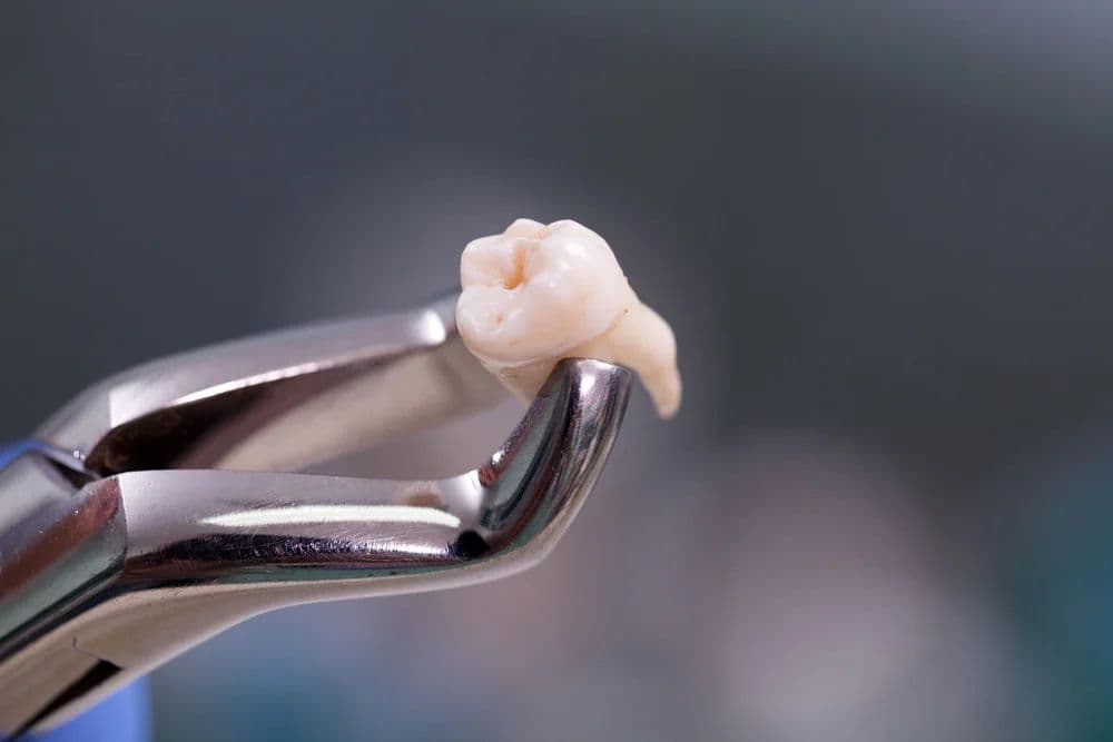 Complex Tooth Extractions
